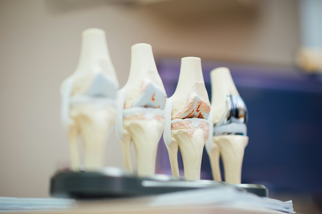 How Synovial Fluid Depletion Causes Joint Stiffness and Pain